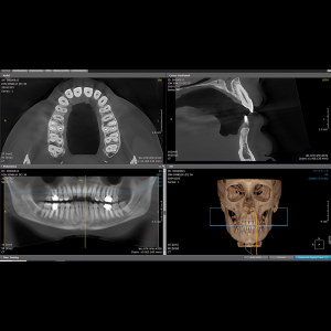 מכשיר סיטי CBCT משולב פנורמי Dentri